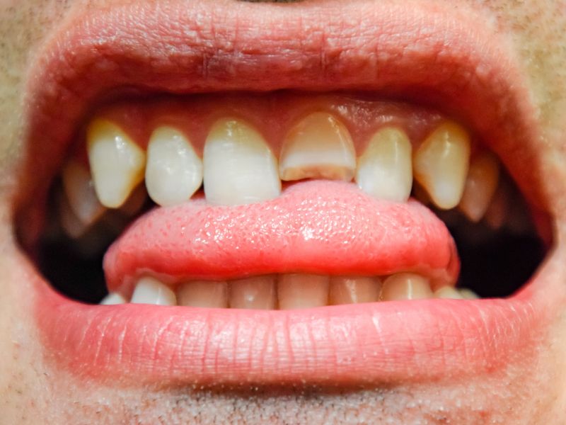 cuando acudir a una urgencia dental