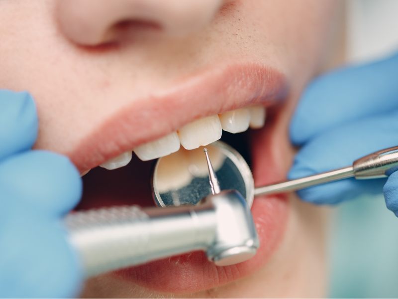 Importancia de la limpieza dental