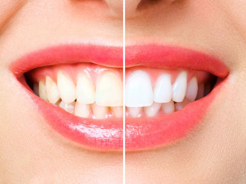 estética orofacial, antes y después del blanqueamiento dental
