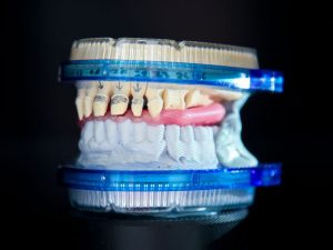 prótesis, rehabilitación protésica