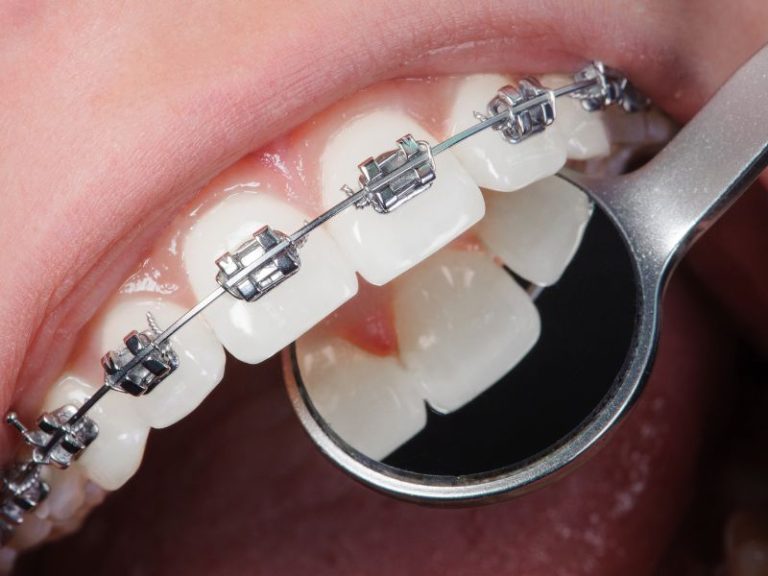 limpieza dental