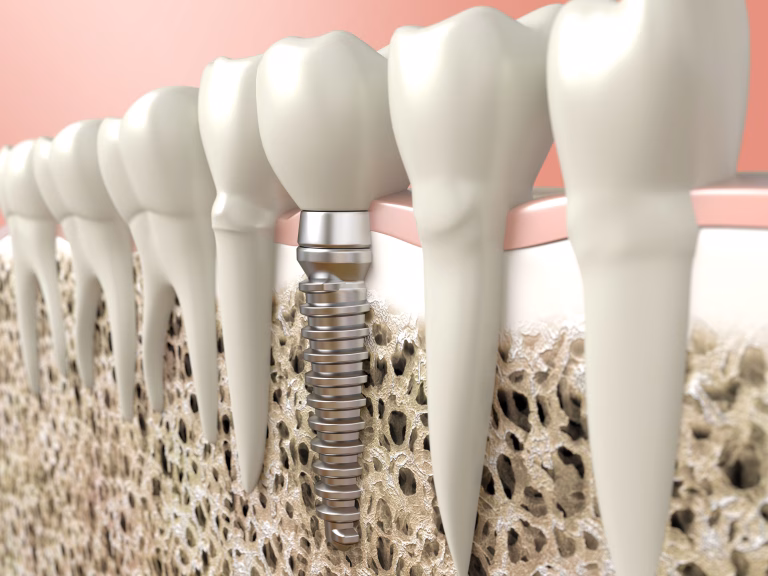 Implante dental en Colina