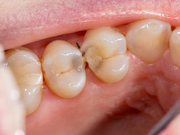 caries ocultas