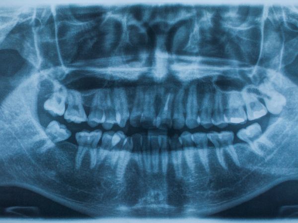 caries ocultas