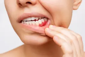 Persona muestra sus encías con gingivitis