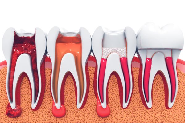 diente después de una endodoncia