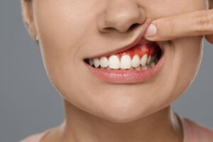 Absceso dental