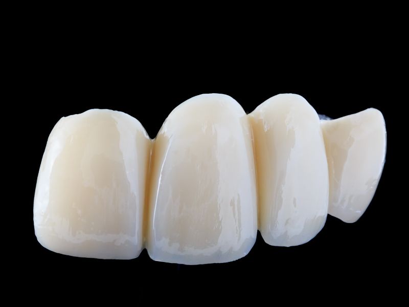 puentes dentales