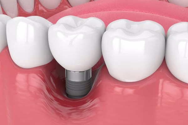 periimplantitis